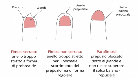 Prepuzio e glande