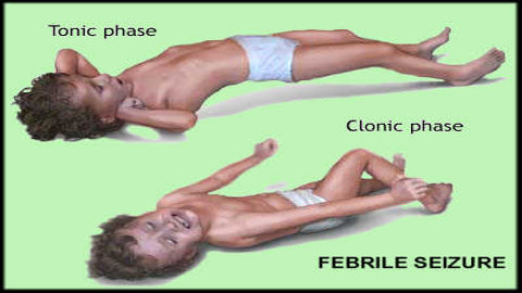 convulsioni-febbrili-bambini