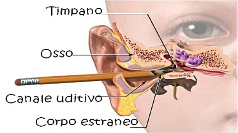 corpo estraneo orecchio